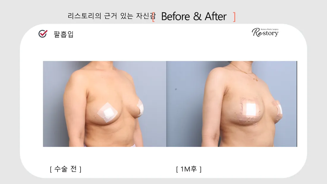 Body Before & After — Restory Plastic Surgery