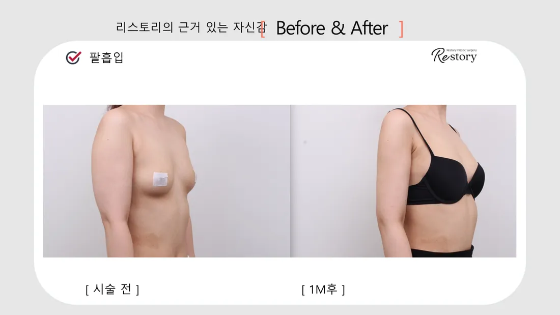 Body Before & After — Restory Plastic Surgery