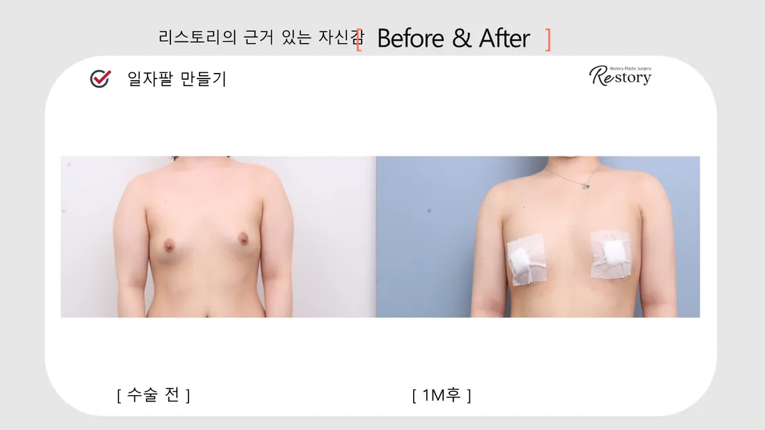 Body Before & After — Restory Plastic Surgery