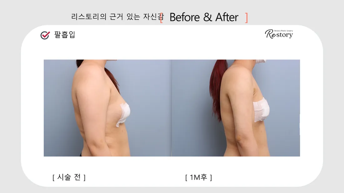 Body Before & After — Restory Plastic Surgery