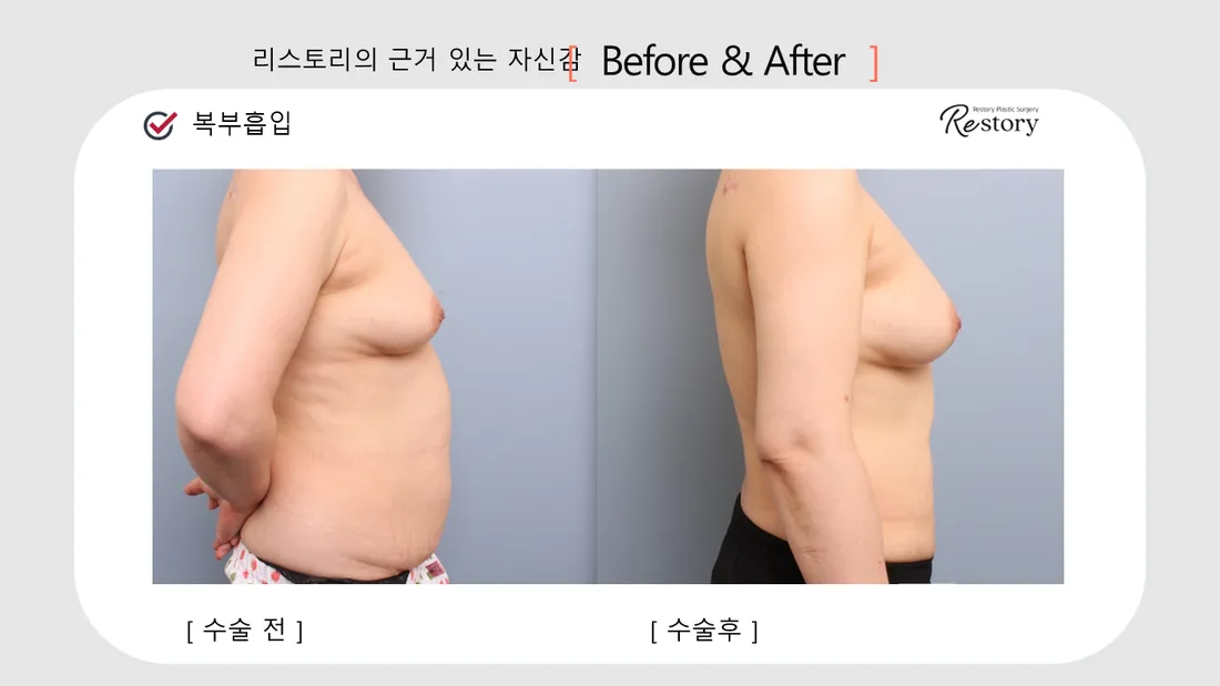Body Before & After — Restory Plastic Surgery