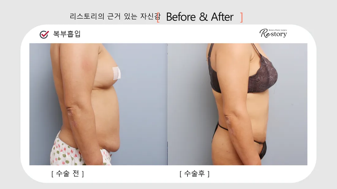 Body Before & After — Restory Plastic Surgery