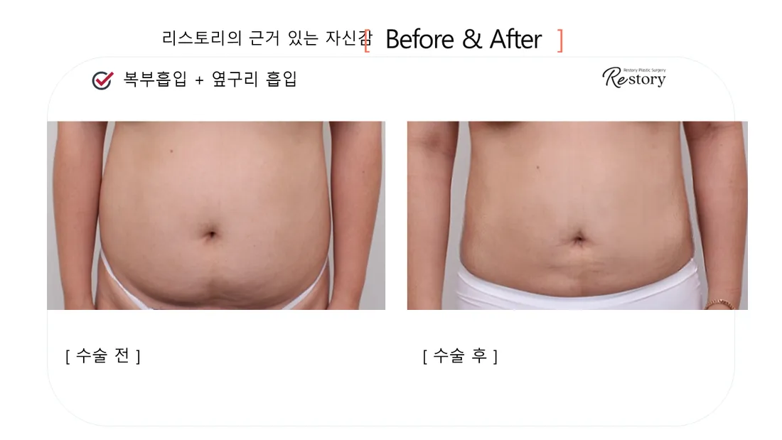 Body Before & After — Restory Plastic Surgery