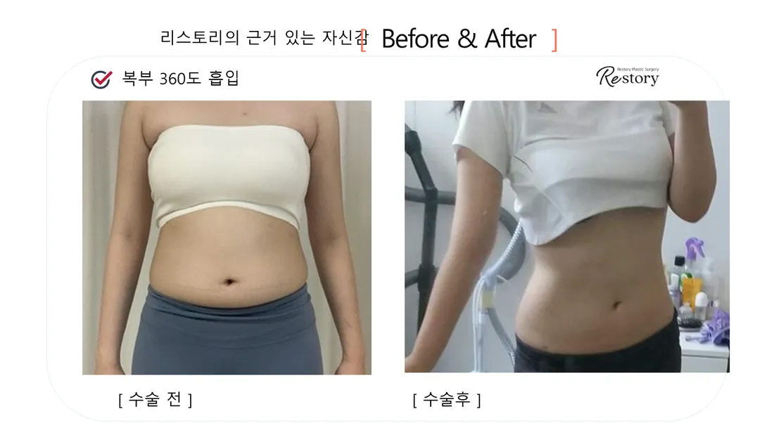Body Before & After — Restory Plastic Surgery