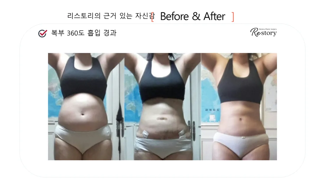 Body Before & After — Restory Plastic Surgery
