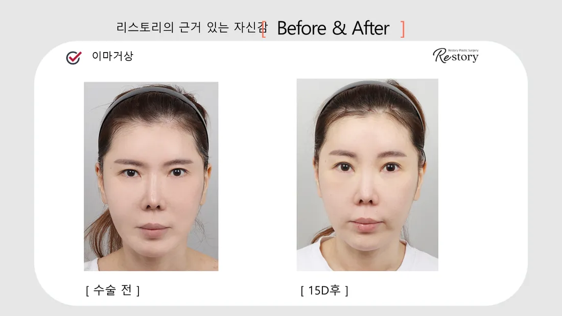 Facial Contour & Forehead Before & After — Restory Plastic Surgery