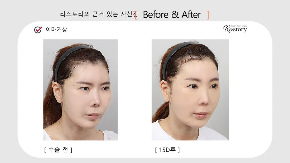 Facial Contour & Forehead Before & After — Restory Plastic Surgery