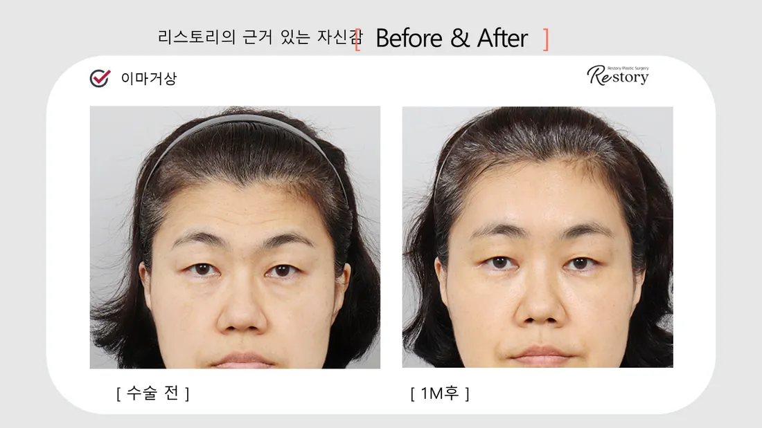 Facial Contour & Forehead Before & After — Restory Plastic Surgery