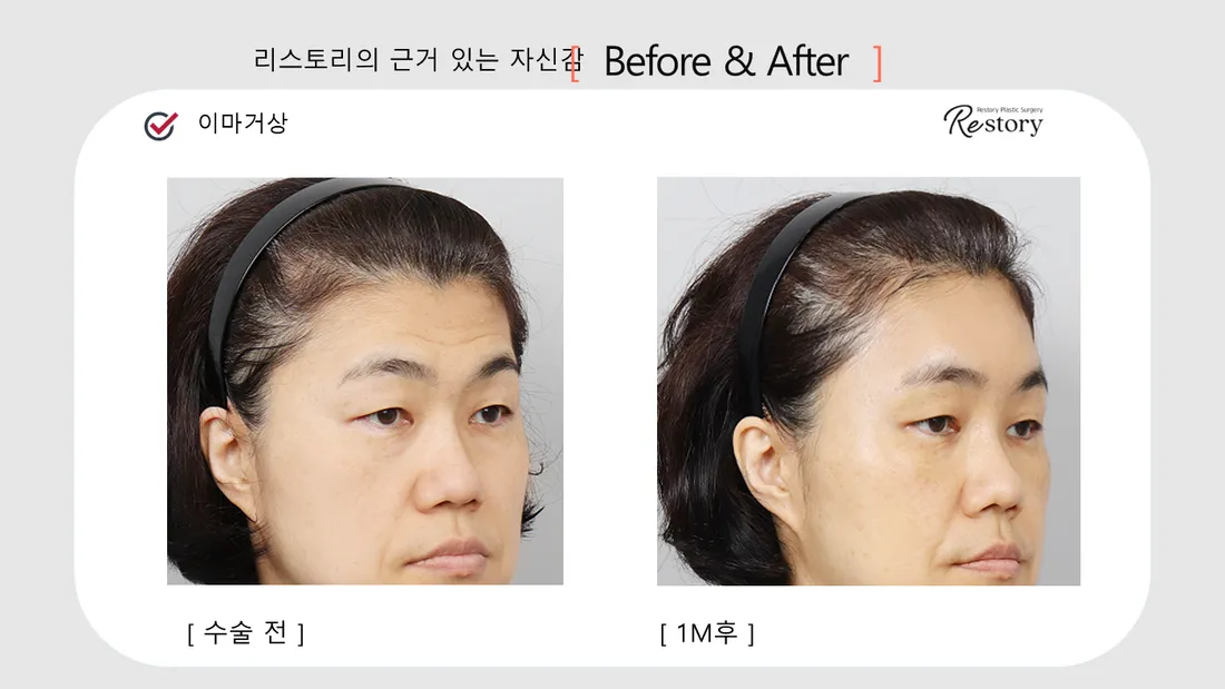 Facial Contour & Forehead Before & After — Restory Plastic Surgery
