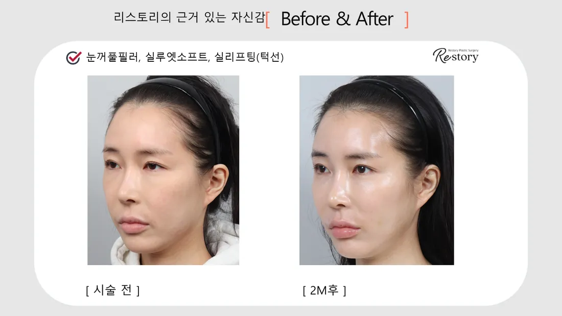 Facial Contour & Forehead Before & After — Restory Plastic Surgery