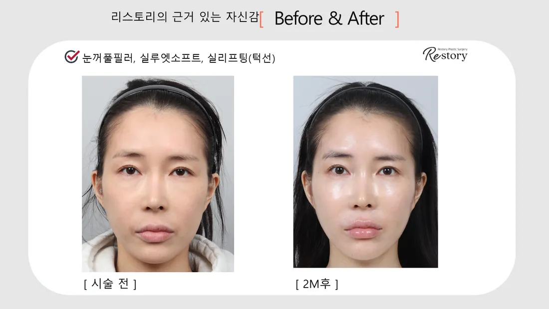 Facial Contour & Forehead Before & After — Restory Plastic Surgery