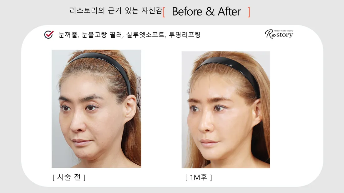 Facial Contour & Forehead Before & After — Restory Plastic Surgery