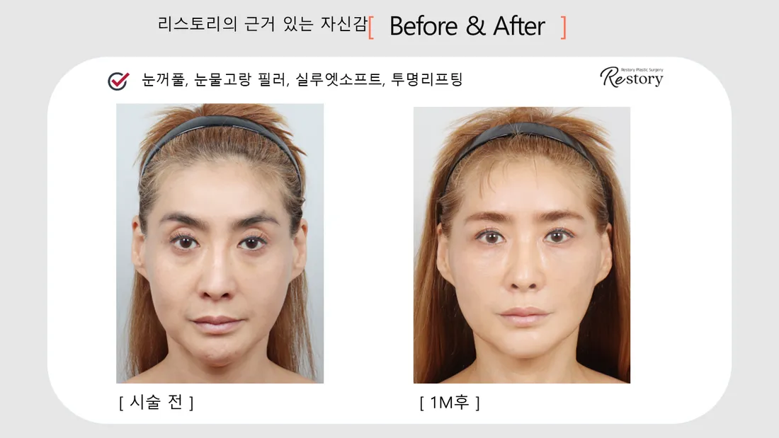 Facial Contour & Forehead Before & After — Restory Plastic Surgery