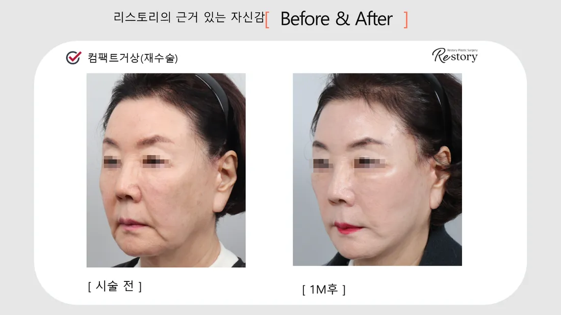 Facial Contour & Forehead Before & After — Restory Plastic Surgery