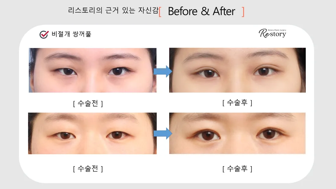 Eyes Before & After — Restory Plastic Surgery