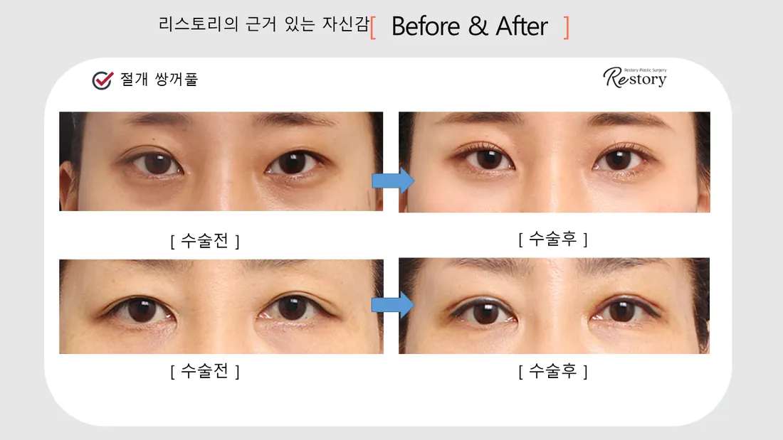 Eyes Before & After — Restory Plastic Surgery