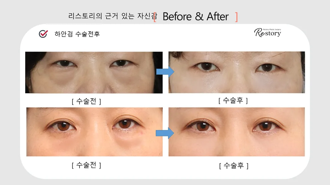 Eyes Before & After — Restory Plastic Surgery
