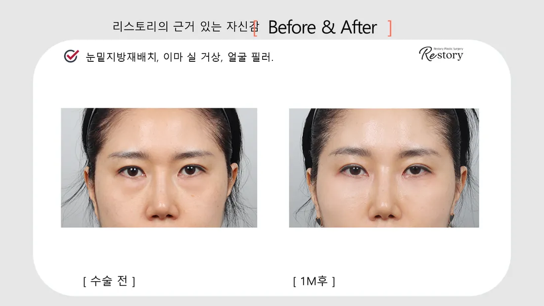 Eyes Before & After — Restory Plastic Surgery