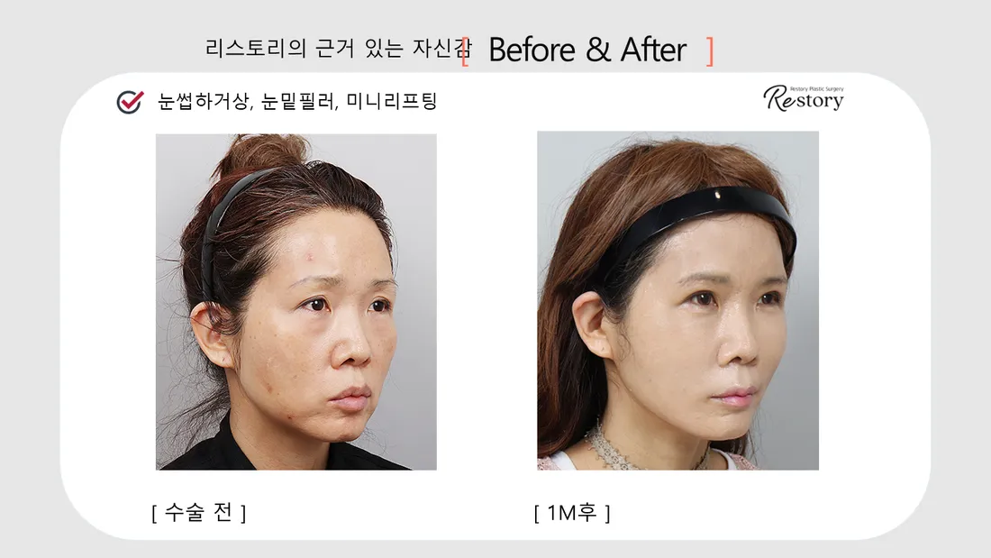Eyes Before & After — Restory Plastic Surgery