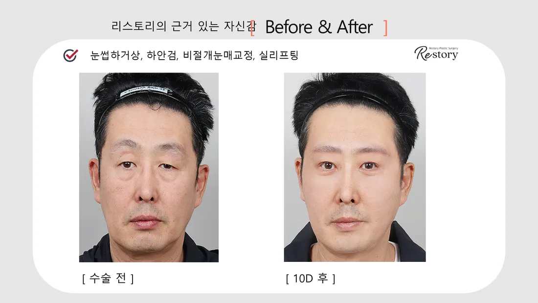 Eyes Before & After — Restory Plastic Surgery