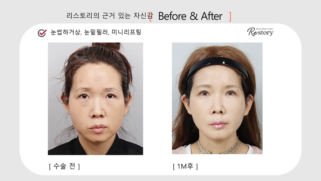 Eyes Before & After — Restory Plastic Surgery