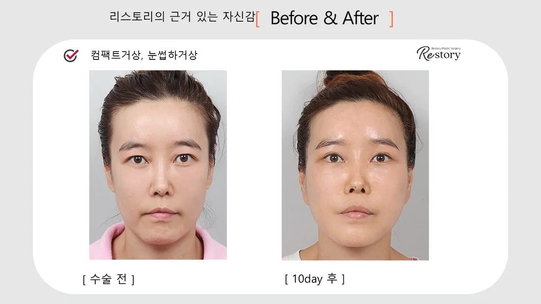 Eyes Before & After — Restory Plastic Surgery