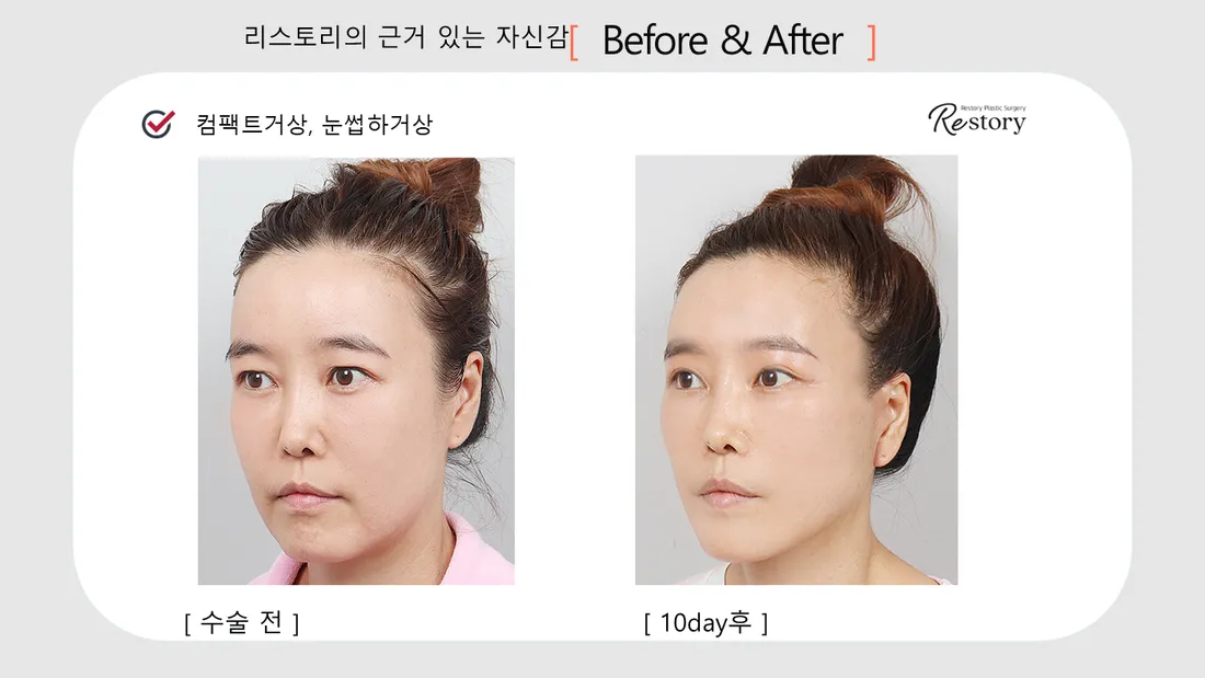Eyes Before & After — Restory Plastic Surgery