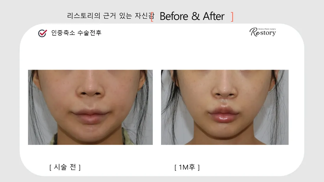 Jaw, lip & dental Before & After — Restory Plastic Surgery