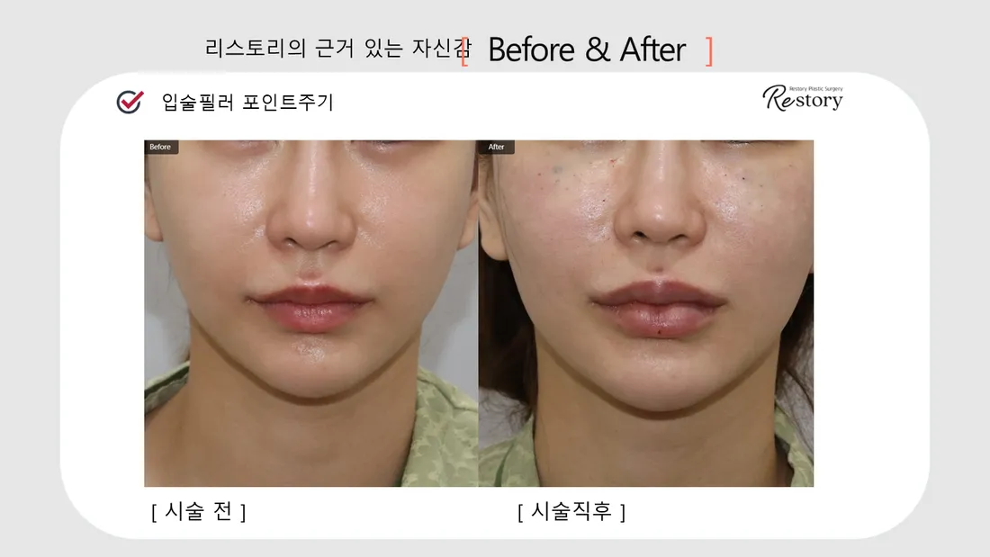 Jaw, lip & dental Before & After — Restory Plastic Surgery