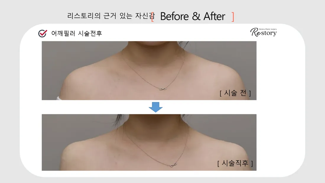 Neck & Shoulders Before & After — Restory Plastic Surgery