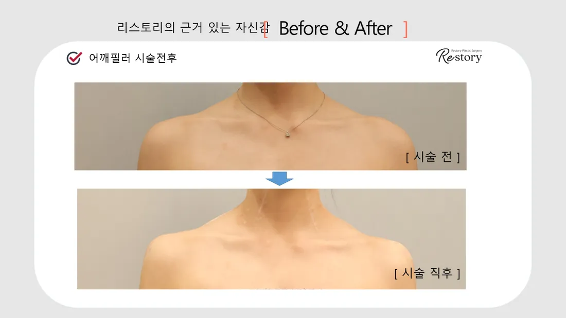 Neck & Shoulders Before & After — Restory Plastic Surgery