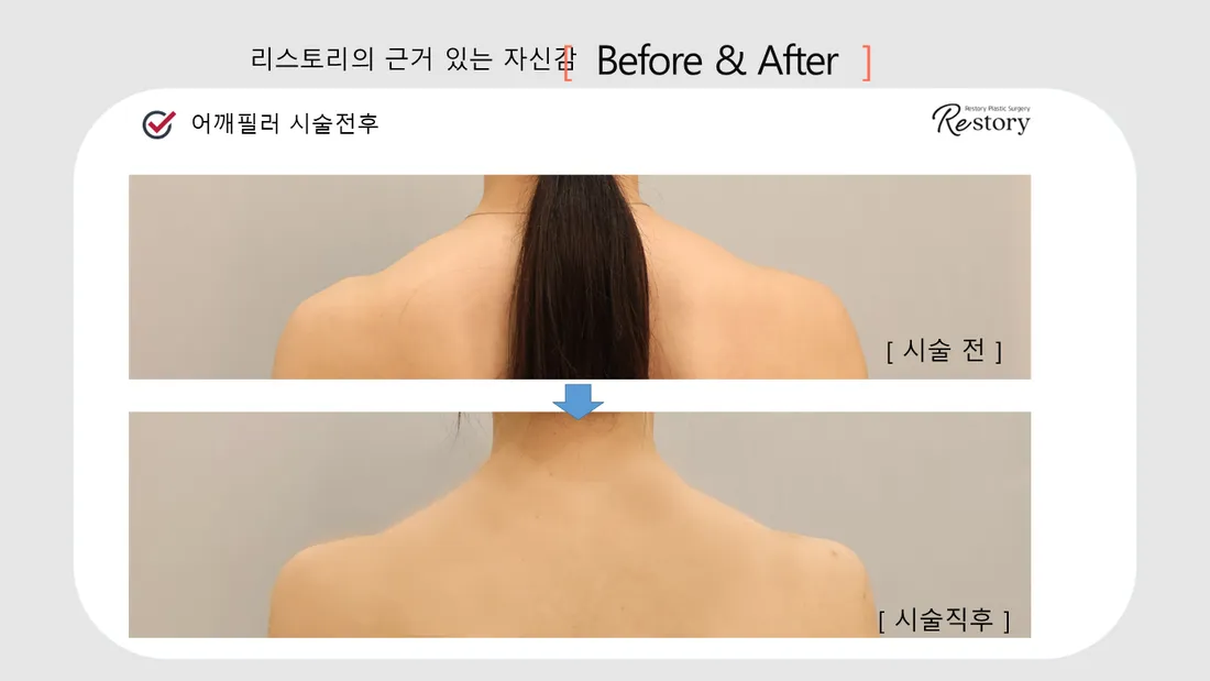 Neck & Shoulders Before & After — Restory Plastic Surgery
