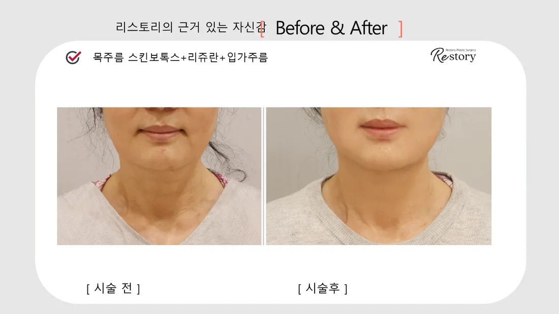 Neck & Shoulders Before & After — Restory Plastic Surgery