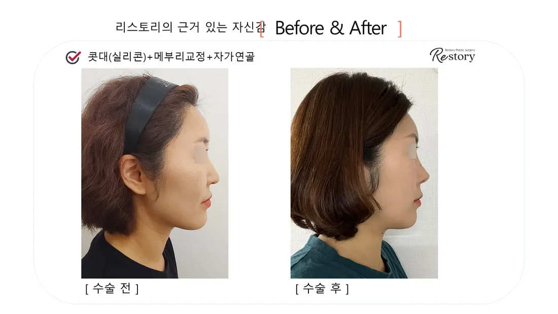 Nose Before & After — Restory Plastic Surgery