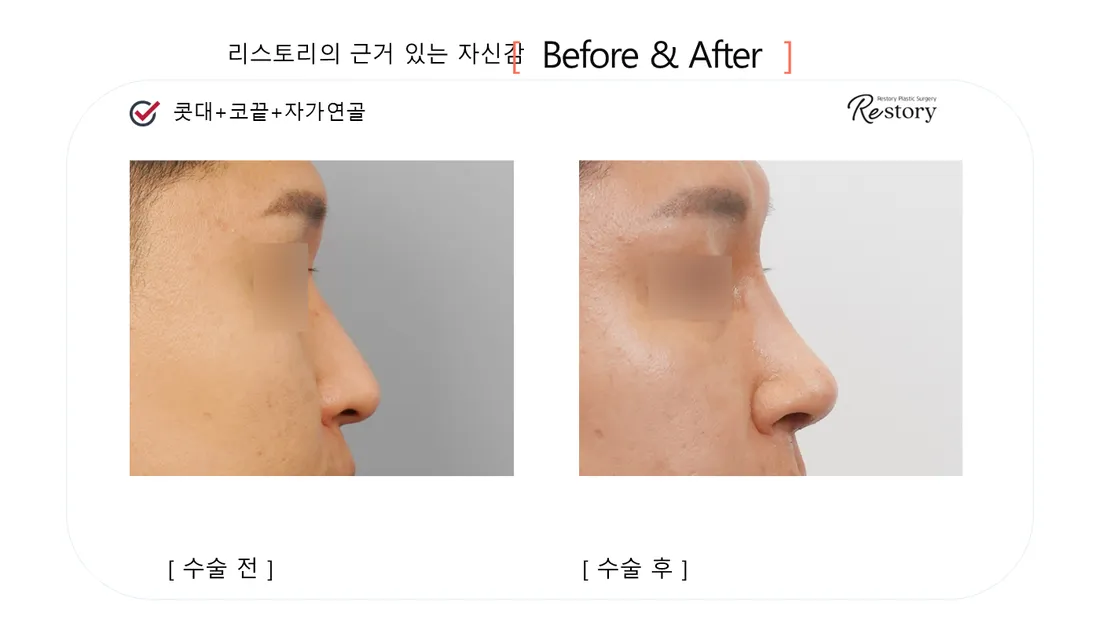 Nose Before & After — Restory Plastic Surgery