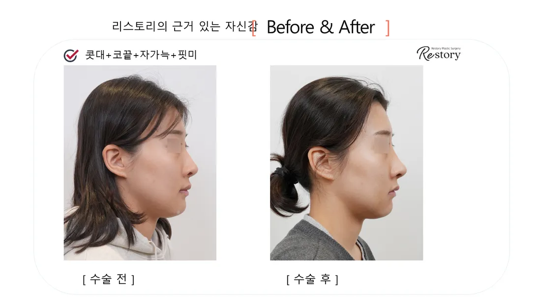 Nose Before & After — Restory Plastic Surgery