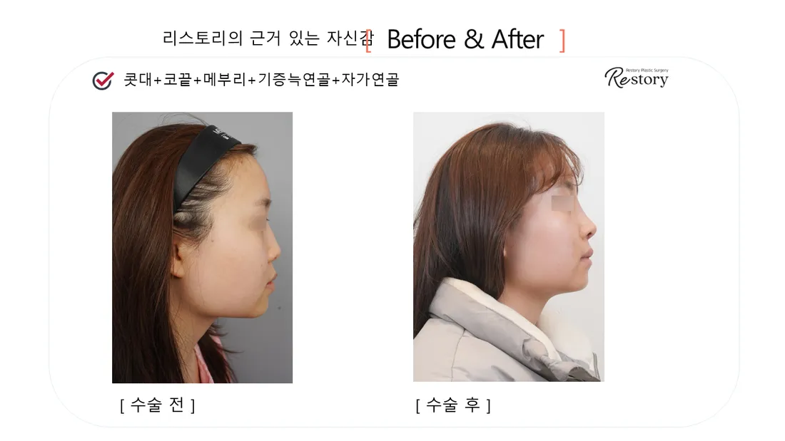 Nose Before & After — Restory Plastic Surgery