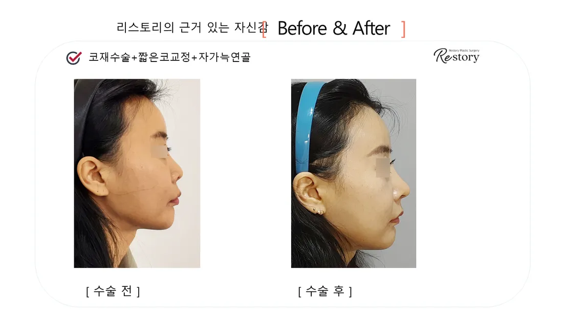 Nose Before & After — Restory Plastic Surgery