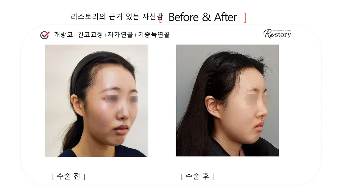 Nose Before & After — Restory Plastic Surgery