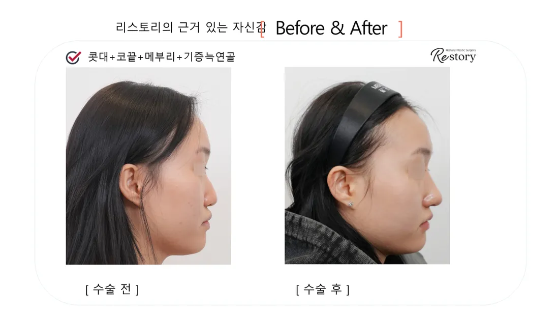 Nose Before & After — Restory Plastic Surgery
