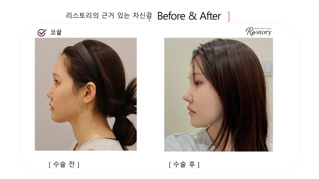 Nose Before & After — Restory Plastic Surgery