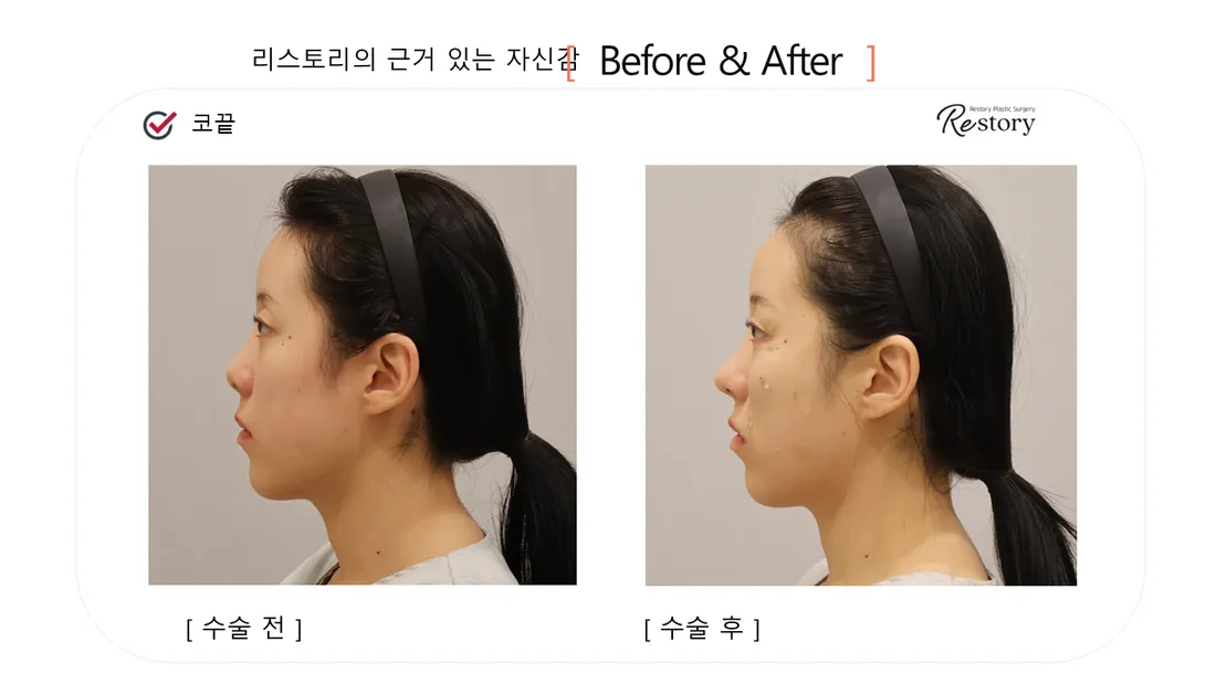 Nose Before & After — Restory Plastic Surgery