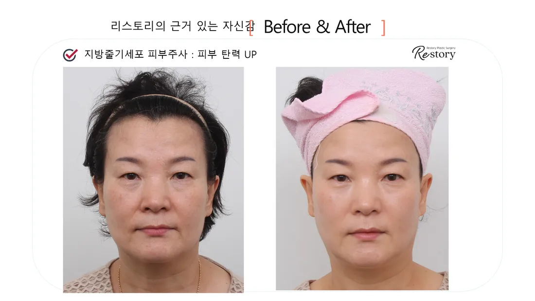 Skin Before & After — Restory Plastic Surgery