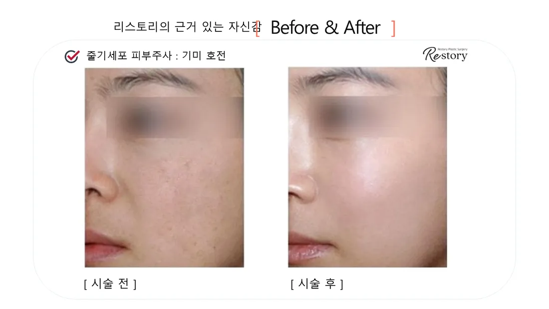 Skin Before & After — Restory Plastic Surgery