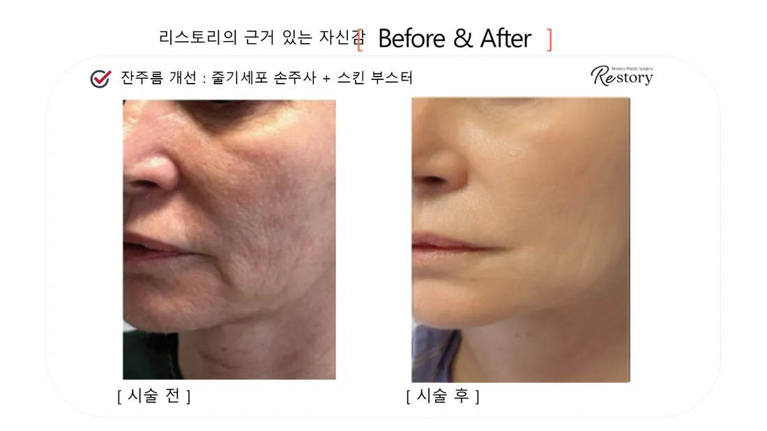 Skin Before & After — Restory Plastic Surgery