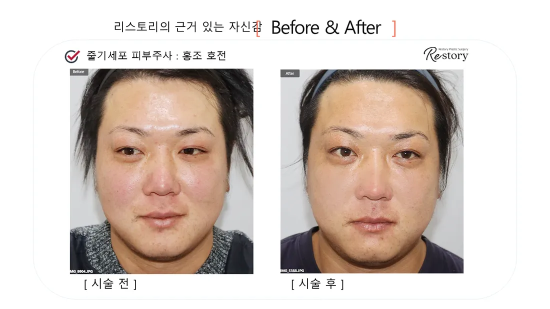 Skin Before & After — Restory Plastic Surgery