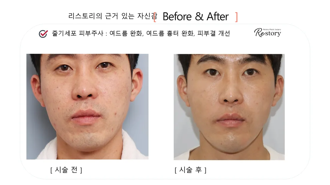 Skin Before & After — Restory Plastic Surgery