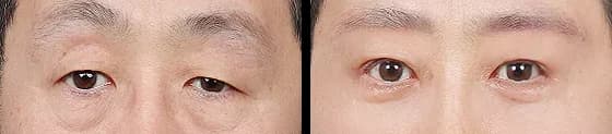 Eyes Before & After — Restory Plastic Surgery