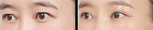 Eyes Before & After — Restory Plastic Surgery