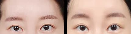 Eyes Before & After — Restory Plastic Surgery